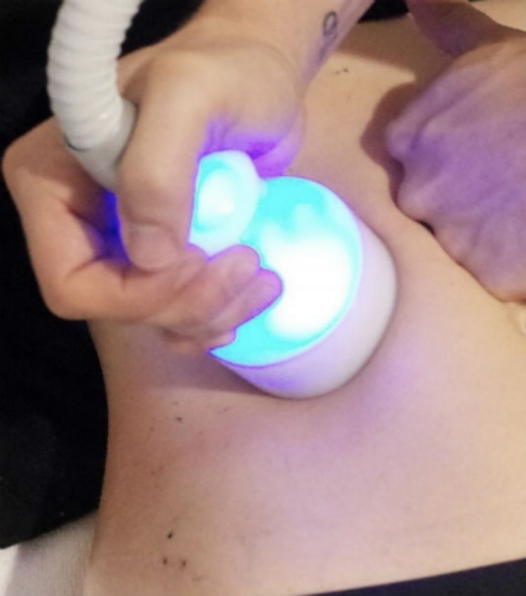 CryoSlimming